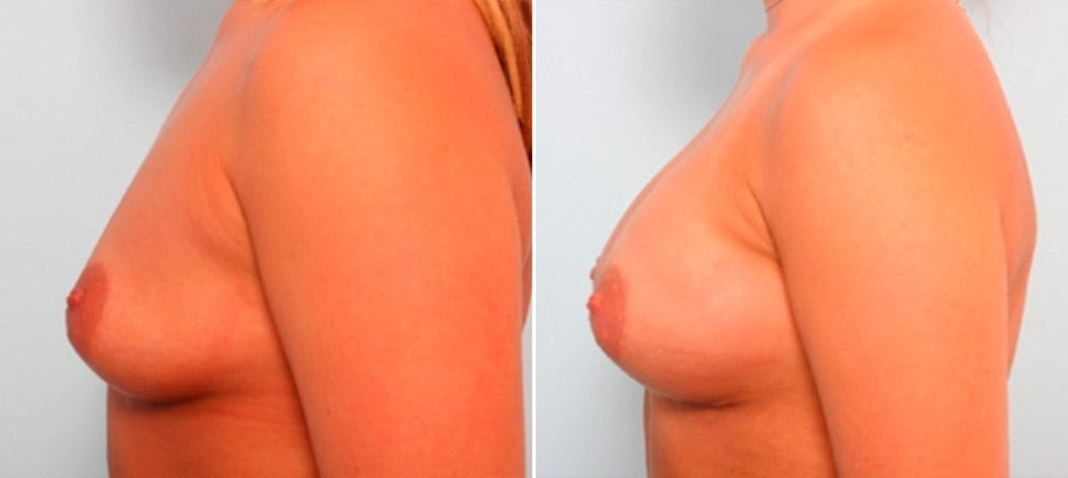 Breast Augmentation Before & After Gallery - Patient 54886916 - Image 5