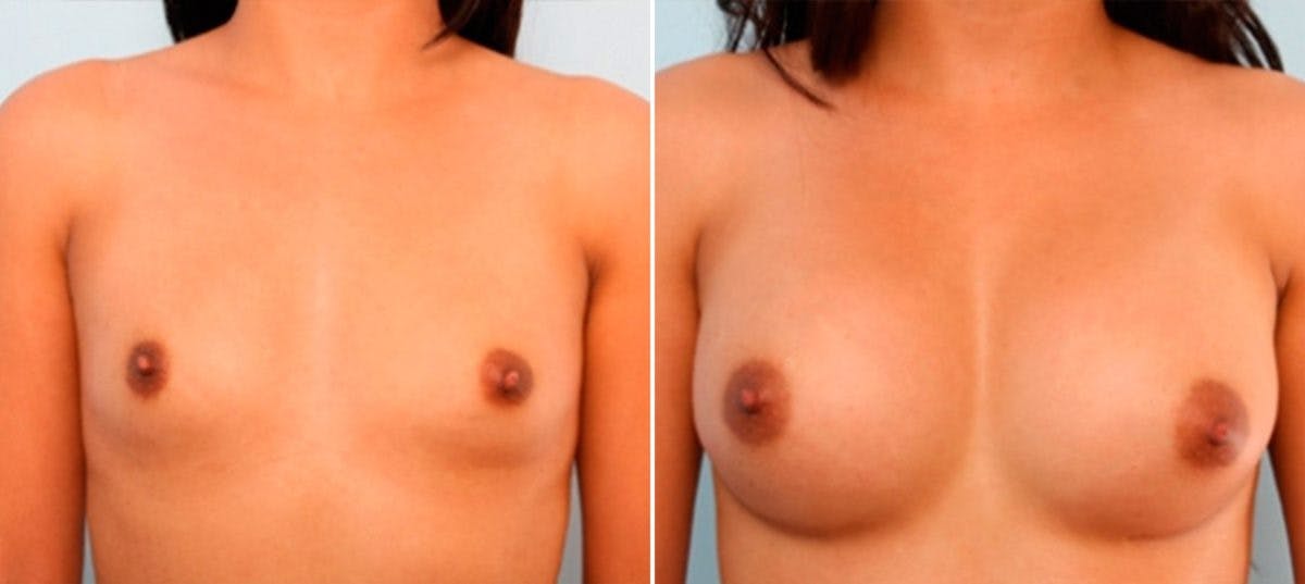 Breast Augmentation Before & After Gallery - Patient 54886921 - Image 1