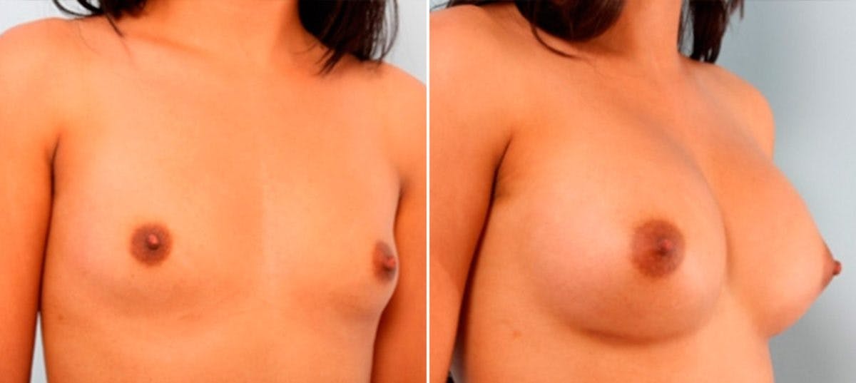Breast Augmentation Before & After Photo - Patient 54886921 - Image 2