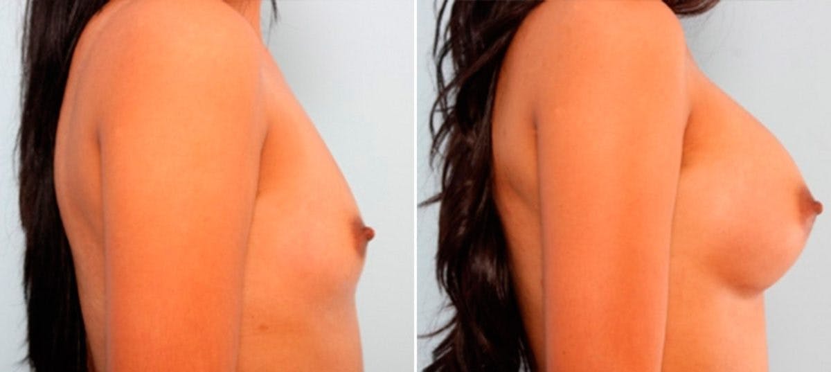 Breast Augmentation Before & After Photo - Patient 54886921 - Image 3