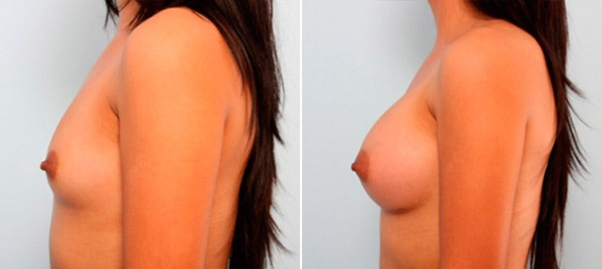 Breast Augmentation Before & After Gallery - Patient 54886921 - Image 5