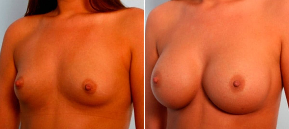 Breast Augmentation Before & After Gallery - Patient 54886922 - Image 4