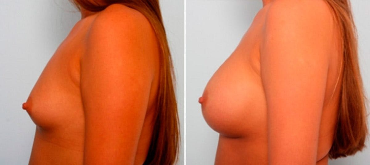 Breast Augmentation Before & After Gallery - Patient 54886922 - Image 5