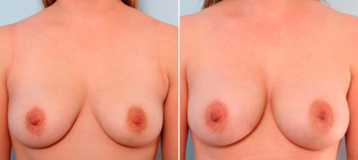 Breast Augmentation Before & After Gallery - Patient 54886925 - Image 1