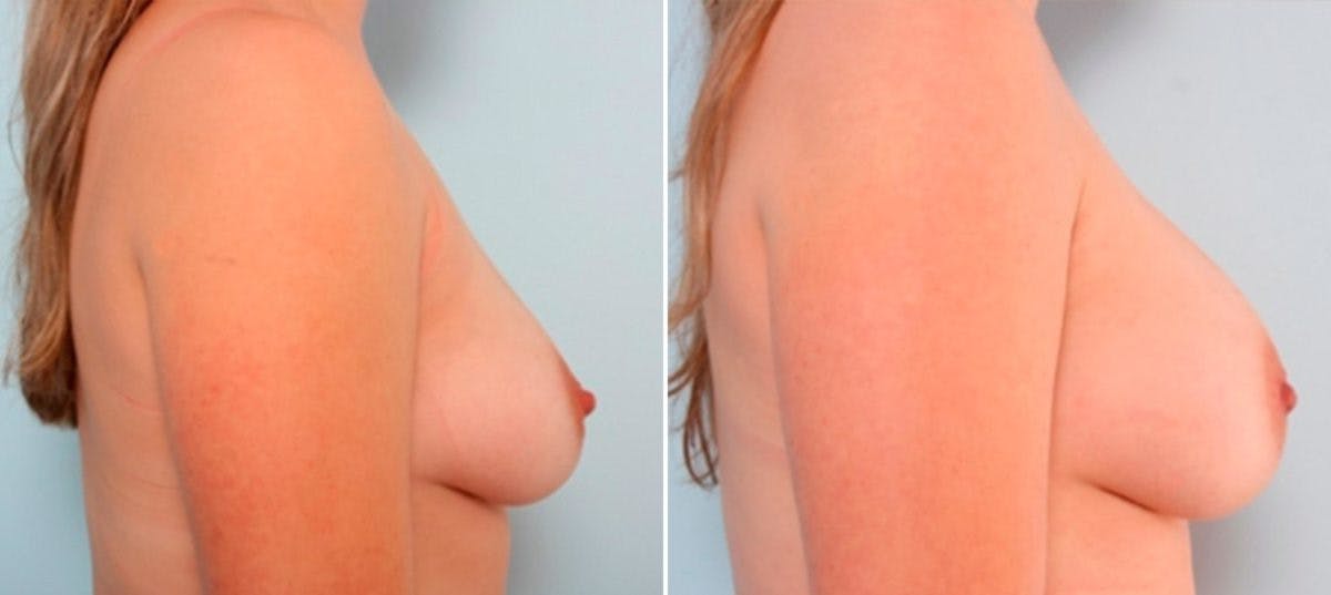 Breast Augmentation Before & After Gallery - Patient 54886925 - Image 3