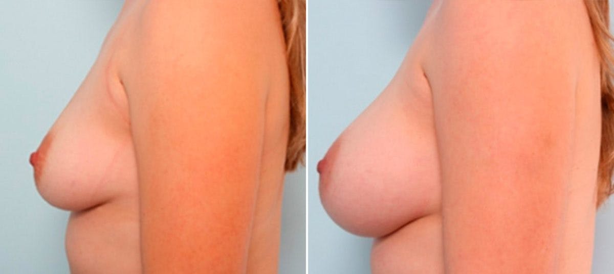 Breast Augmentation Before & After Gallery - Patient 54886925 - Image 5