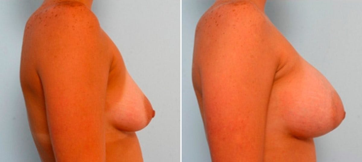 Breast Augmentation Before & After Gallery - Patient 54886927 - Image 3