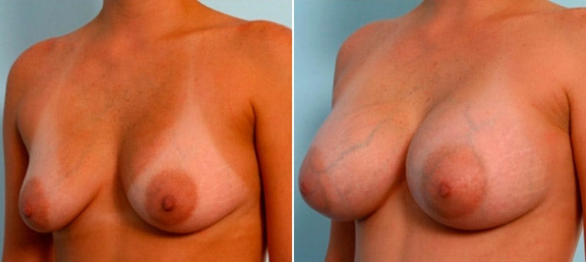 Breast Augmentation Before & After Gallery - Patient 54886927 - Image 4