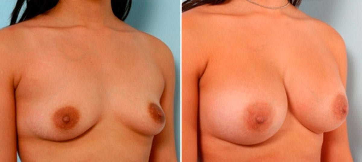Breast Augmentation Before & After Photo - Patient 54886929 - Image 2