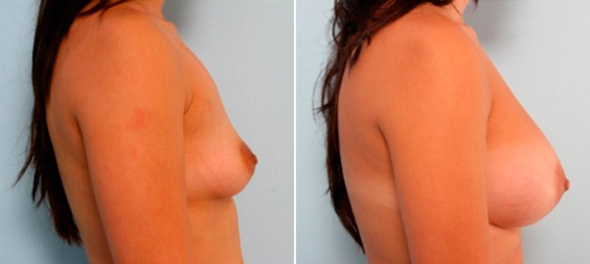 Breast Augmentation Before & After Photo - Patient 54886929 - Image 3