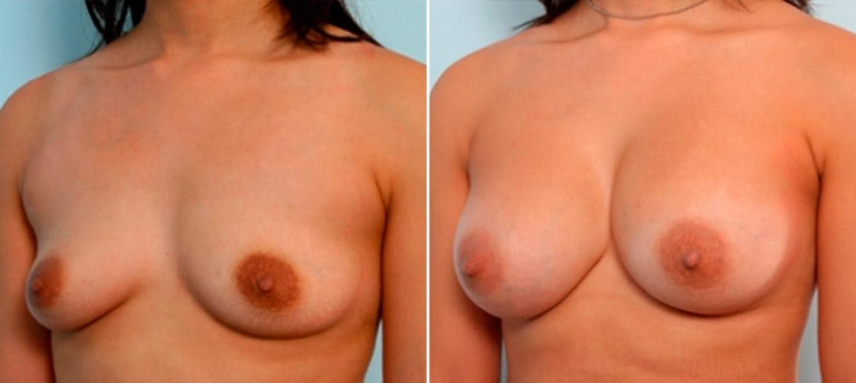Breast Augmentation Before & After Gallery - Patient 54886929 - Image 4
