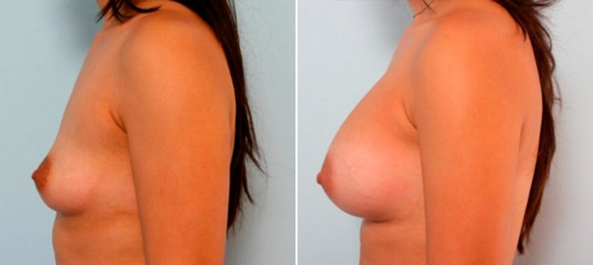Breast Augmentation Before & After Photo - Patient 54886929 - Image 5