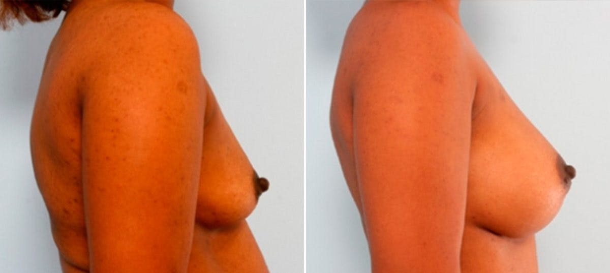 Breast Augmentation Before & After Gallery - Patient 54886933 - Image 3