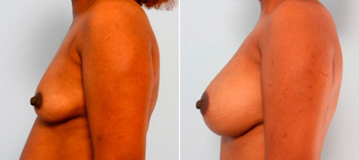 Breast Augmentation Before & After Gallery - Patient 54886933 - Image 5