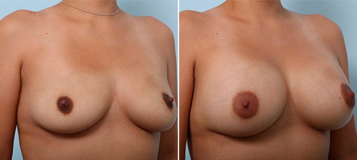 Breast Augmentation Before & After Photo - Patient 54886934 - Image 2