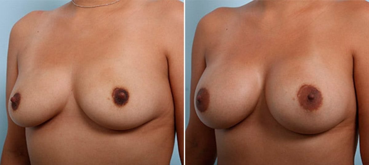 Breast Augmentation Before & After Gallery - Patient 54886934 - Image 4
