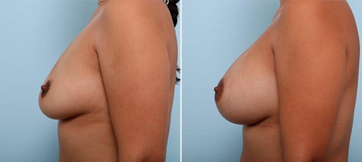 Breast Augmentation Before & After Gallery - Patient 54886934 - Image 5