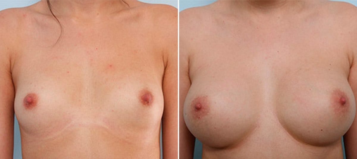 Breast Augmentation Before & After Gallery - Patient 54886935 - Image 1