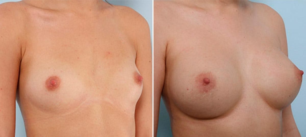 Breast Augmentation Before & After Gallery - Patient 54886935 - Image 2