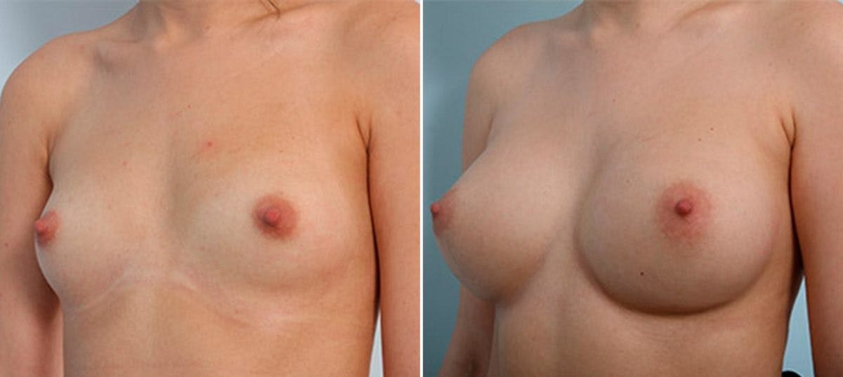 Breast Augmentation Before & After Gallery - Patient 54886935 - Image 4
