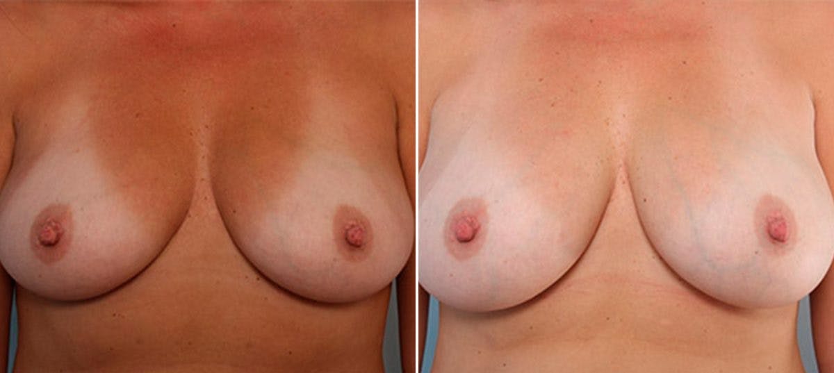 Breast Augmentation Before & After Gallery - Patient 54886939 - Image 1
