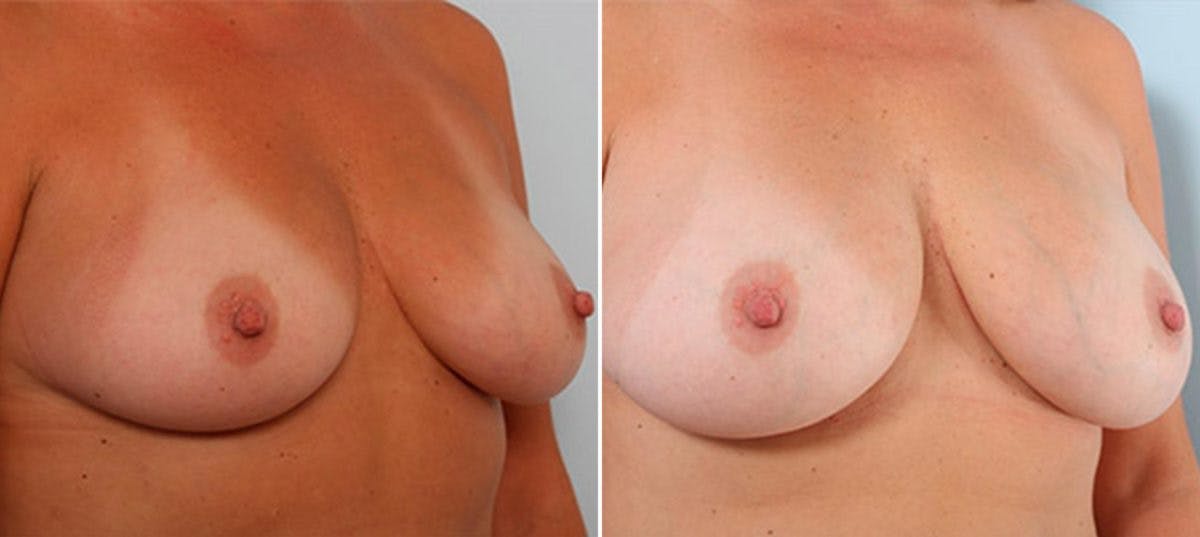Breast Augmentation Before & After Gallery - Patient 54886939 - Image 2