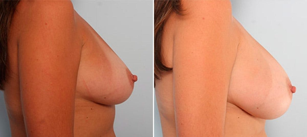 Breast Augmentation Before & After Gallery - Patient 54886939 - Image 3