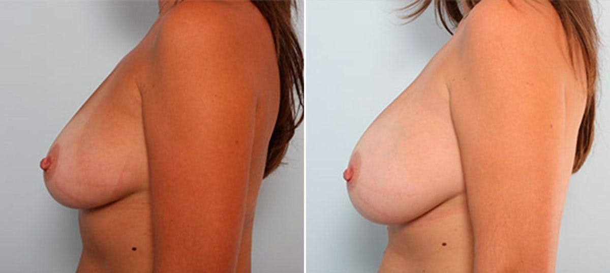 Breast Augmentation Before & After Gallery - Patient 54886939 - Image 5