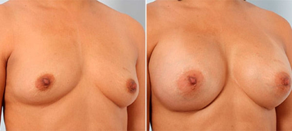 Breast Augmentation Before & After Gallery - Patient 54886940 - Image 2