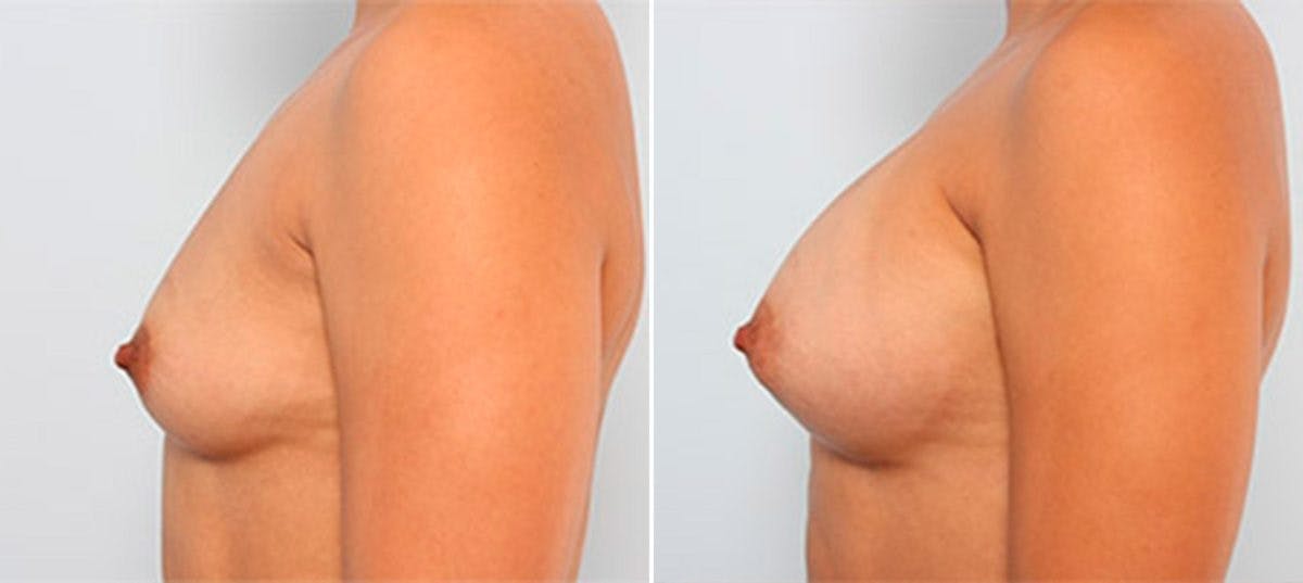 Breast Augmentation Before & After Photo - Patient 54886940 - Image 5