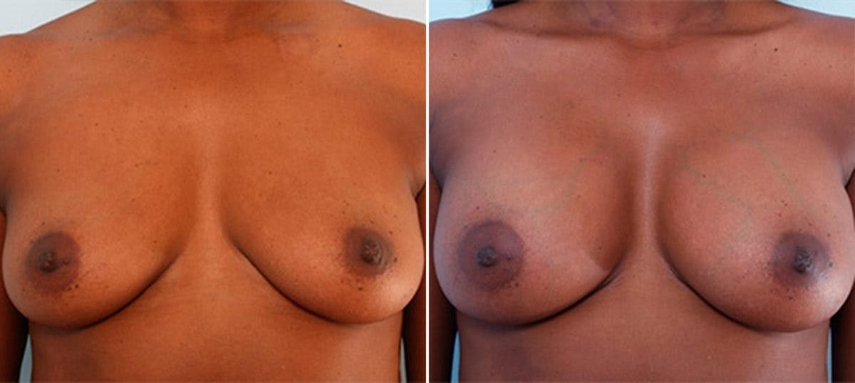 Breast Augmentation Before & After Gallery - Patient 54886942 - Image 1