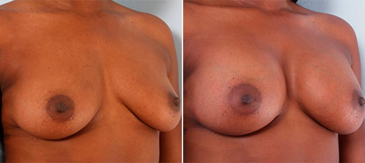 Breast Augmentation Before & After Gallery - Patient 54886942 - Image 2