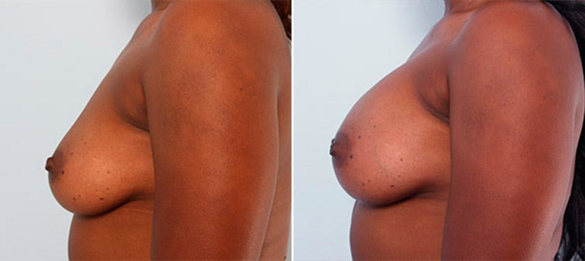 Breast Augmentation Before & After Gallery - Patient 54886942 - Image 5