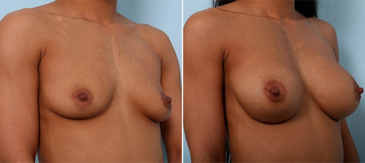 Breast Augmentation Before & After Gallery - Patient 54886944 - Image 2
