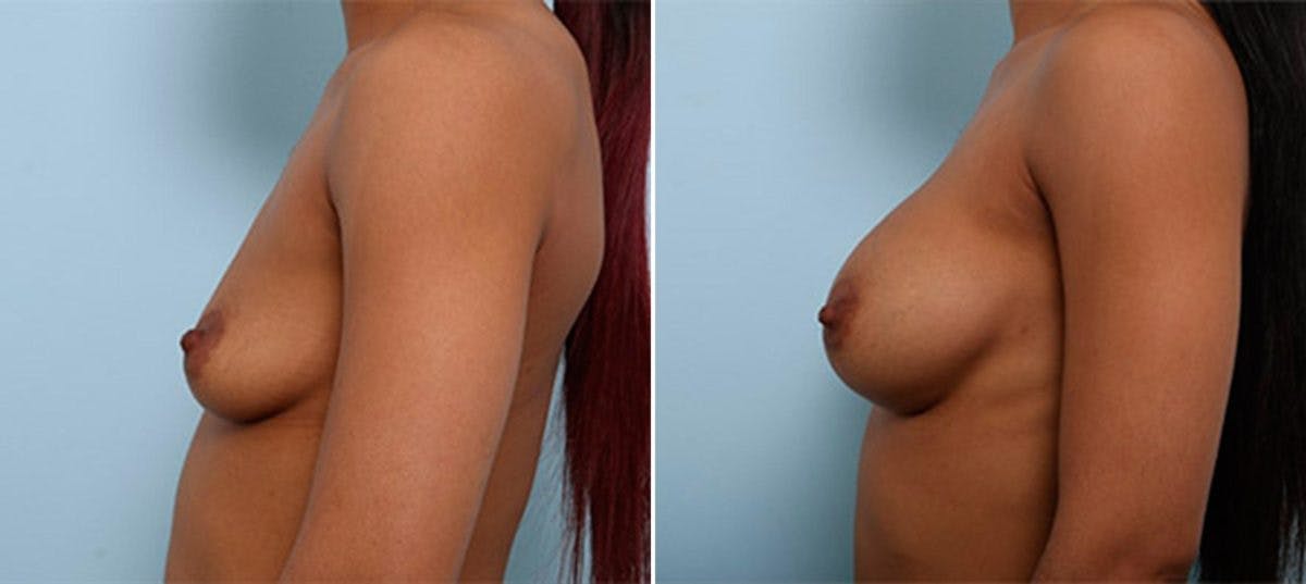 Breast Augmentation Before & After Gallery - Patient 54886944 - Image 5