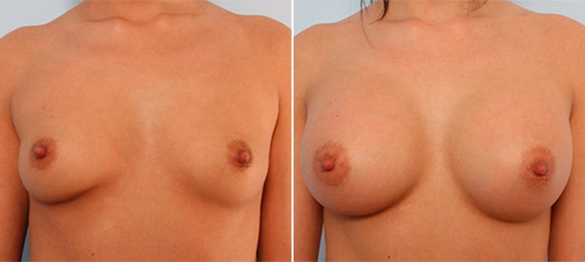 Breast Augmentation Before & After Gallery - Patient 54886945 - Image 1