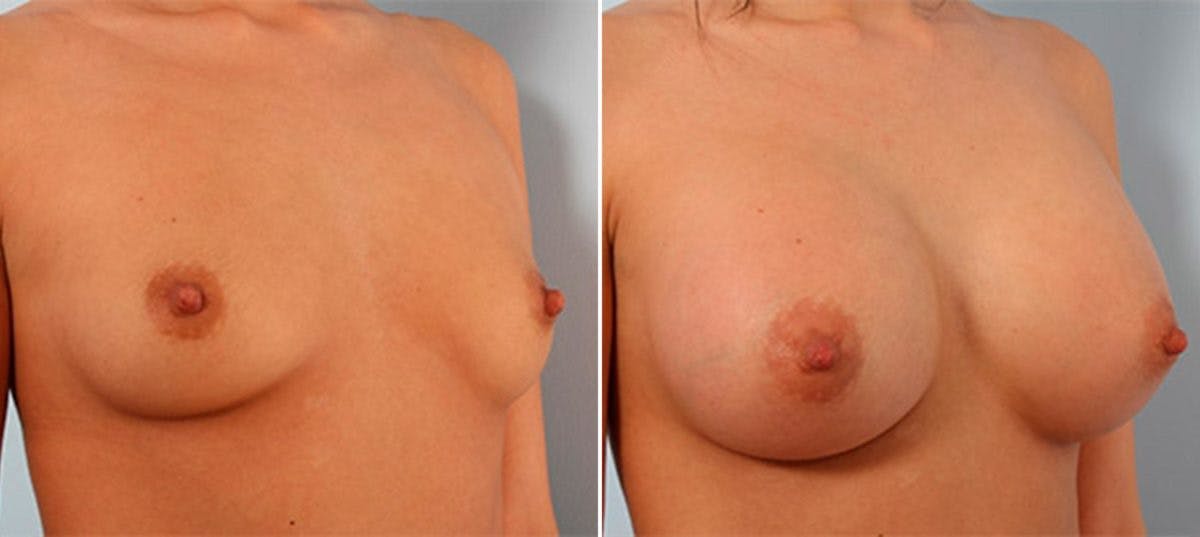 Breast Augmentation Before & After Gallery - Patient 54886945 - Image 2