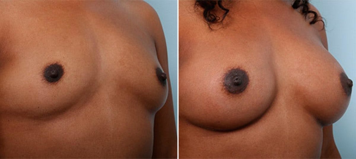 Breast Augmentation Before & After Gallery - Patient 54886949 - Image 2