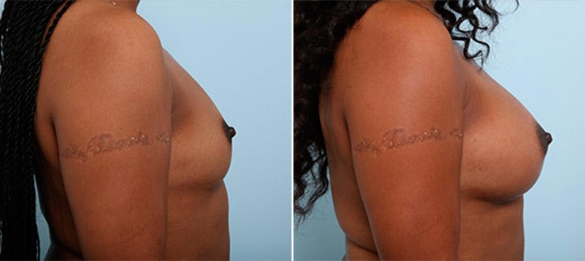 Breast Augmentation Before & After Gallery - Patient 54886949 - Image 3