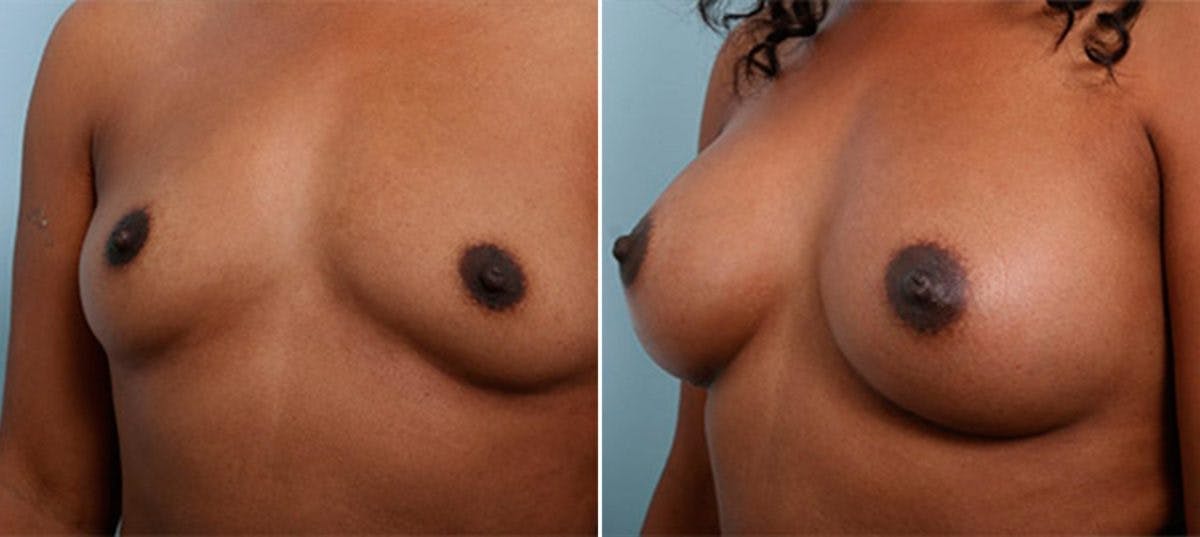 Breast Augmentation Before & After Gallery - Patient 54886949 - Image 4