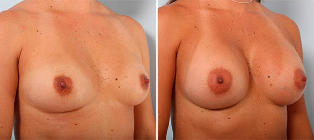 Breast Augmentation Before & After Gallery - Patient 54886952 - Image 2