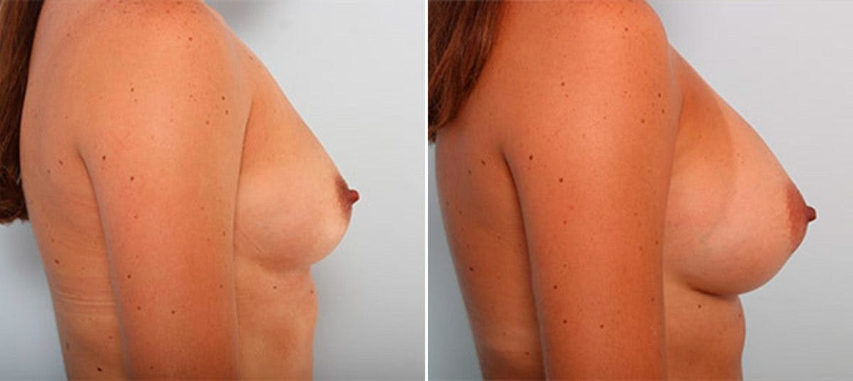 Breast Augmentation Before & After Gallery - Patient 54886952 - Image 3