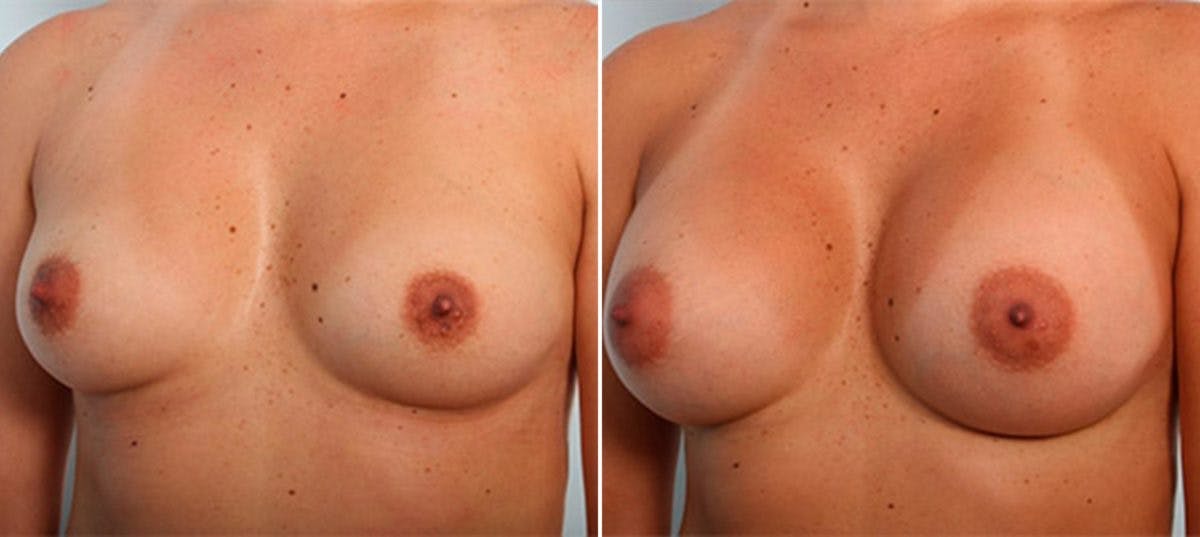 Breast Augmentation Before & After Gallery - Patient 54886952 - Image 4