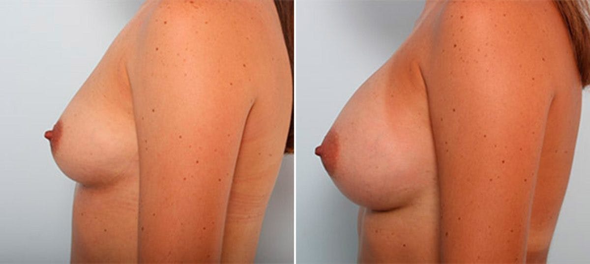 Breast Augmentation Before & After Gallery - Patient 54886952 - Image 5