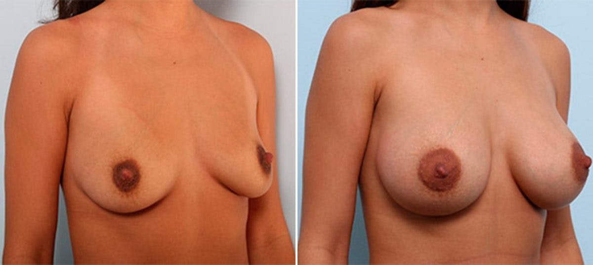 Breast Augmentation Before & After Gallery - Patient 54886954 - Image 2