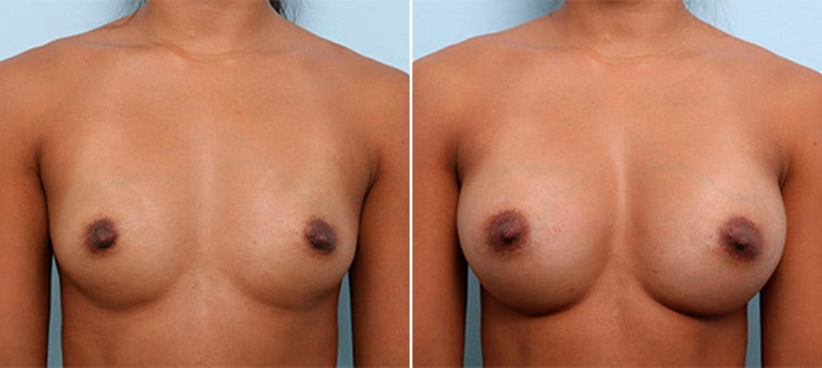 Breast Augmentation Before & After Gallery - Patient 54886956 - Image 1