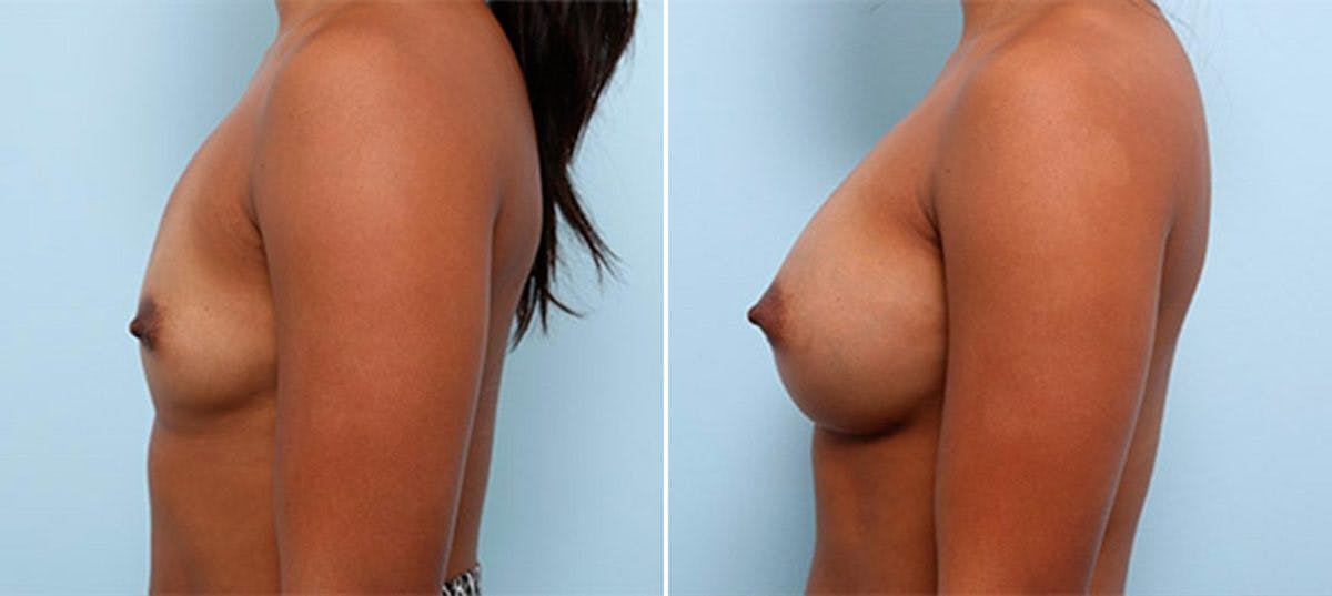 Breast Augmentation Before & After Gallery - Patient 54886956 - Image 5