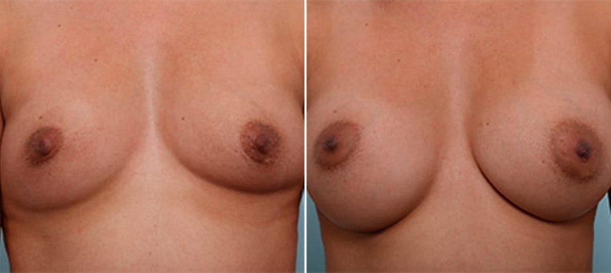 Breast Augmentation Before & After Gallery - Patient 54886962 - Image 1