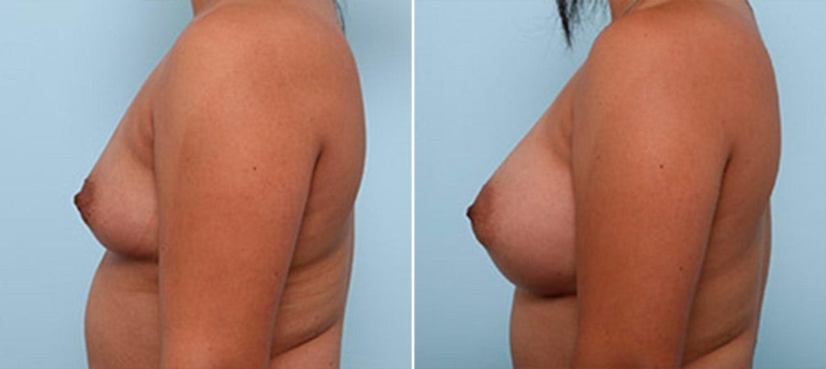 Breast Augmentation Before & After Gallery - Patient 54886962 - Image 5