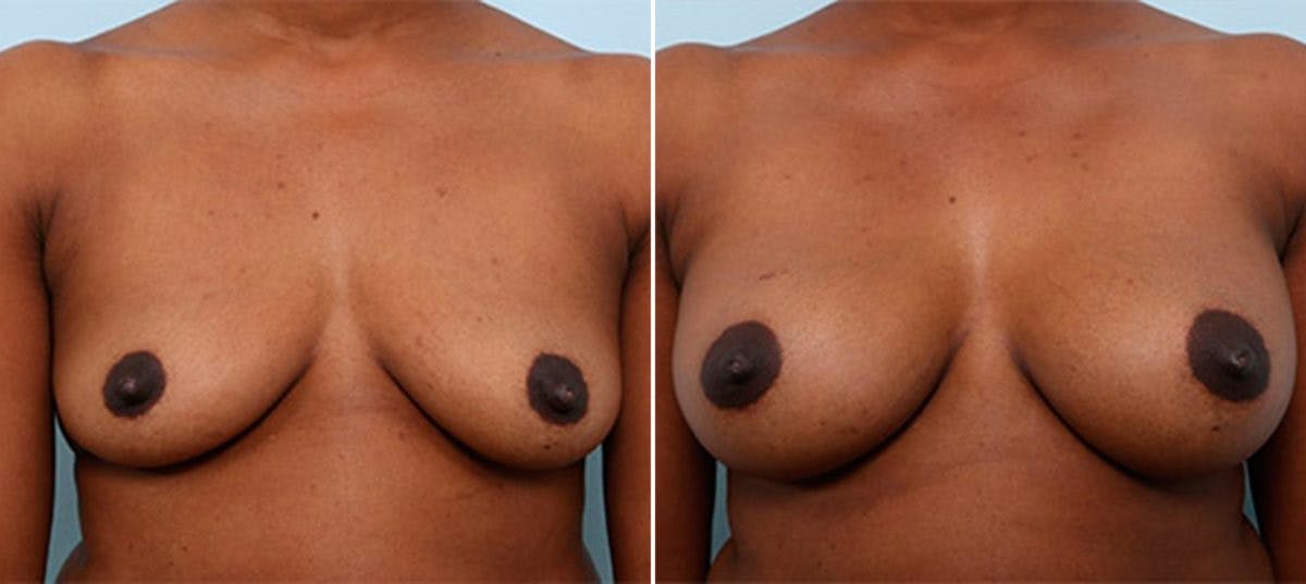 Breast Augmentation Before & After Gallery - Patient 54886963 - Image 1